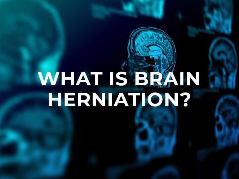 What is Brain Herniation?
