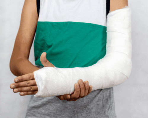 Person with a broken arm in a cast holding their injured arm